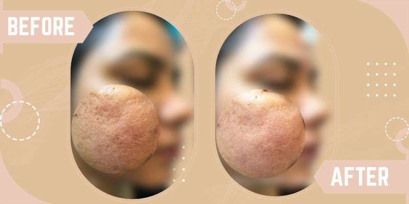 OPEN PORE TREATMENTS before and after result at SkinQure