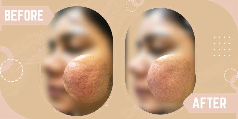 OPEN PORE TREATMENTS before and after result at SkinQure