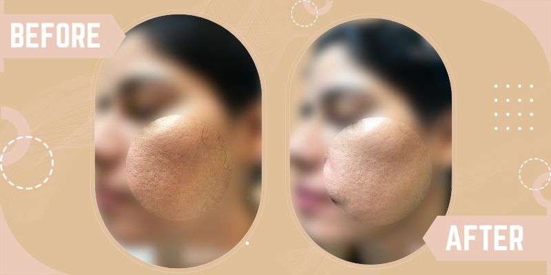 OPEN PORE TREATMENTS before and after result at SkinQure