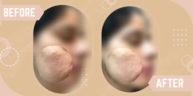 OPEN PORE TREATMENTS before and after result at SkinQure