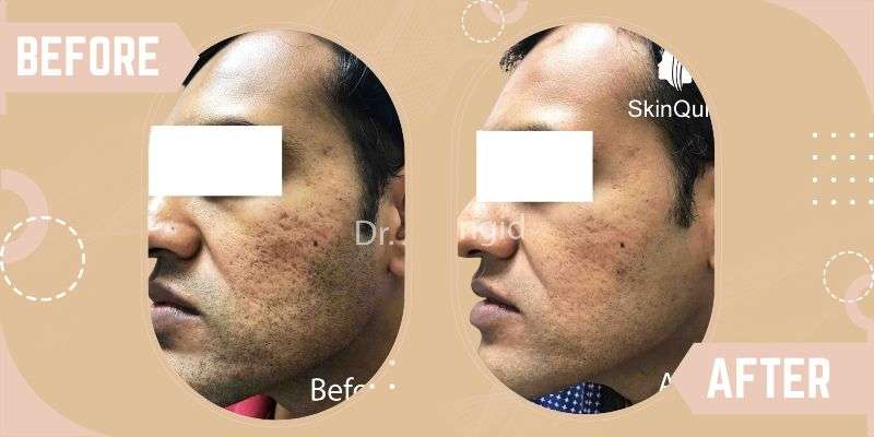 LASER RESURFACING before and after result at SkinQure