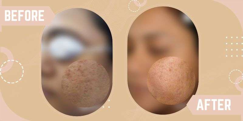 LASER RESURFACING before and after result at SkinQure