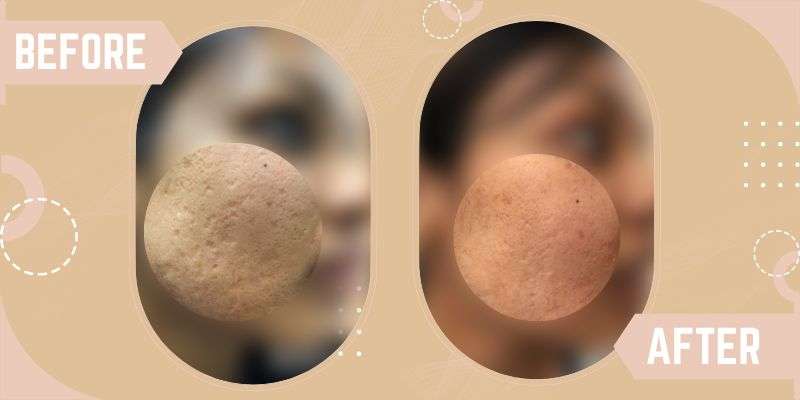 LASER RESURFACING before and after result at SkinQure