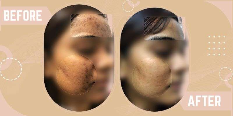 Laser For Acne Scars before and after result at SkinQure