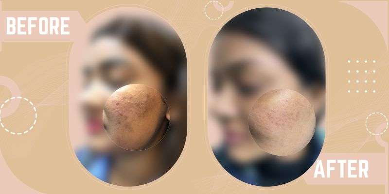 Laser For Acne Scars before and after result at SkinQure