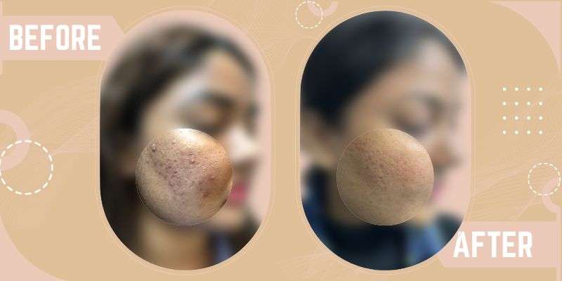 Laser For Acne Scars before and after result at SkinQure
