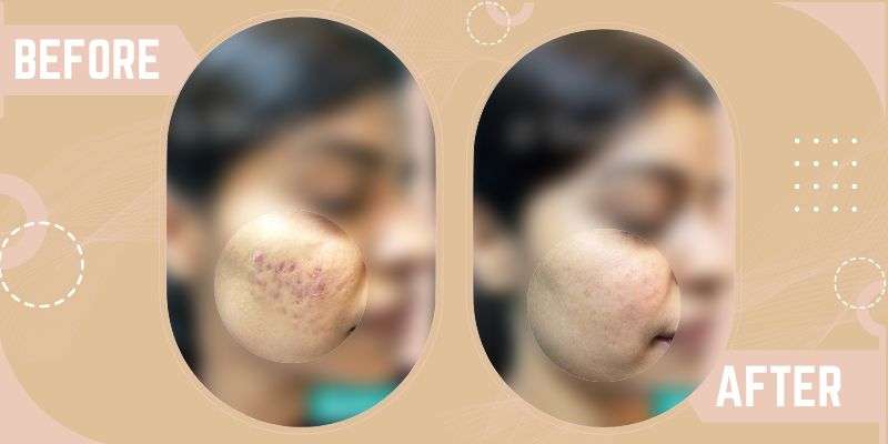 Laser For Acne Scars before and after result at SkinQure