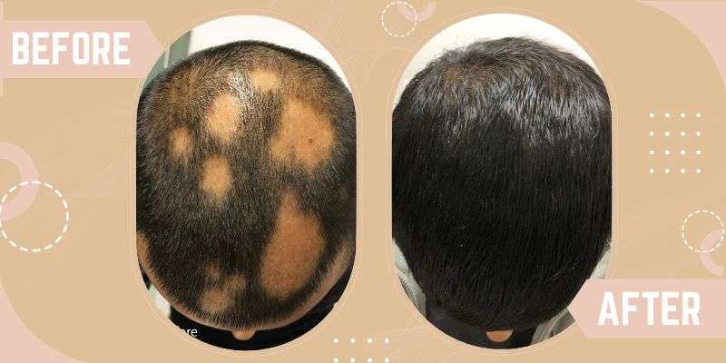 Alopecia Areata before and after result at SkinQure