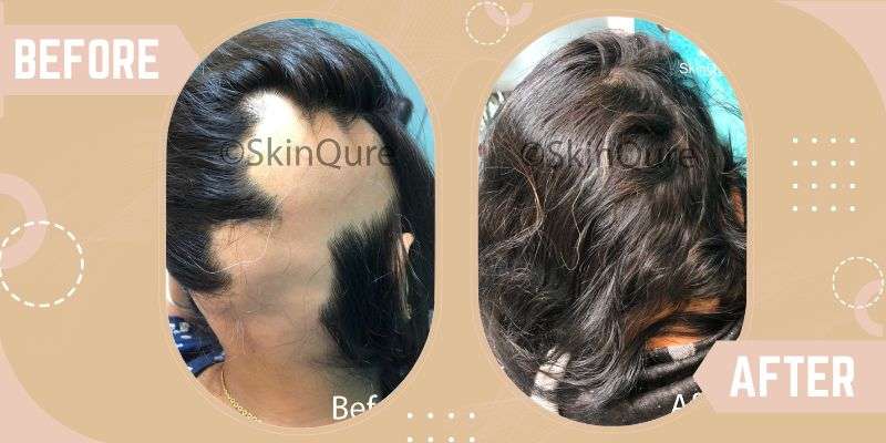 Alopecia Areata before and after result at SkinQure