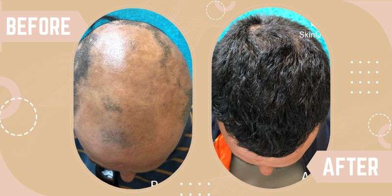 Alopecia Areata before and after result at SkinQure