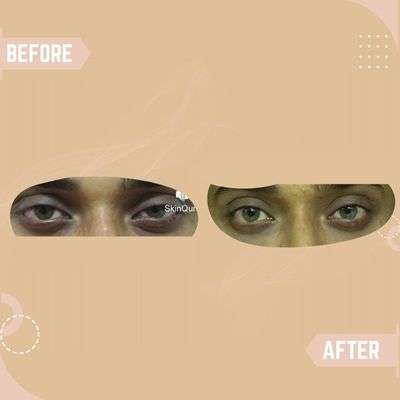 Eye Pigmentation Results