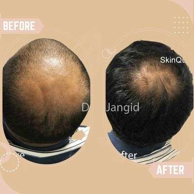 Male Pattern Baldness Results