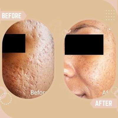 Acne Scars Treatment Results