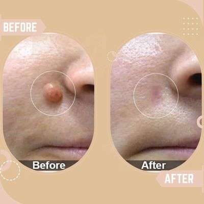 Laser Mole Removal Before After
