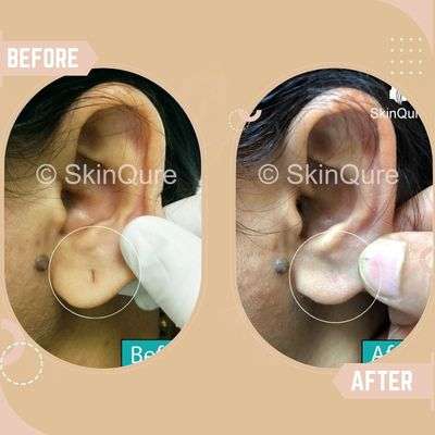 Ear Lobe Repair Results