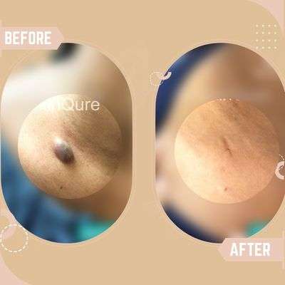 Cyst Removal Results