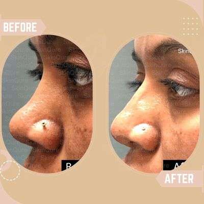 Nose Enhancement Results