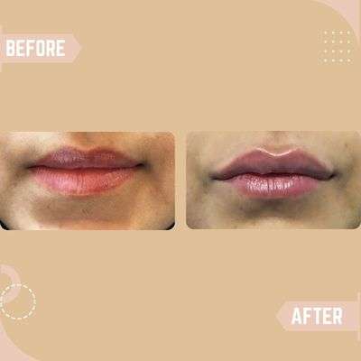 Lip Enhancement Results